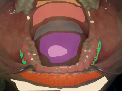 False color image render of a spectral image exhibiting attached gingiva, blood vessel, enamel, hard palate, initial caries, lip, marginal gingiva, oral mucosa, out of focus area, skin, soft palate, specular reflection and tongue