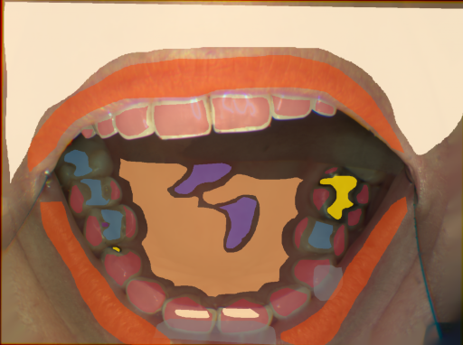 False color image render of a spectral image exhibiting enamel, hard palate, inflammation, initial caries, lip, metal, out of focus area, plastic, skin and specular reflection