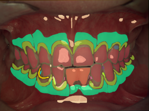 False color image render of a spectral image exhibiting attached gingiva, calculus, dentine caries, enamel, gingivitis, initial caries, marginal gingiva, metal, oral mucosa, plastic, prosthetics and specular reflection