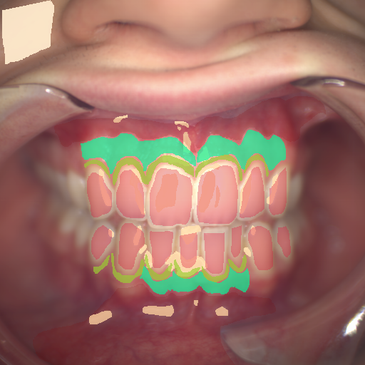 False color image render of a spectral image exhibiting attached gingiva, enamel, marginal gingiva, oral mucosa, skin and specular reflection