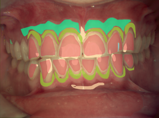 False color image render of a spectral image exhibiting attached gingiva, enamel, marginal gingiva, microfracture, oral mucosa, root and specular reflection