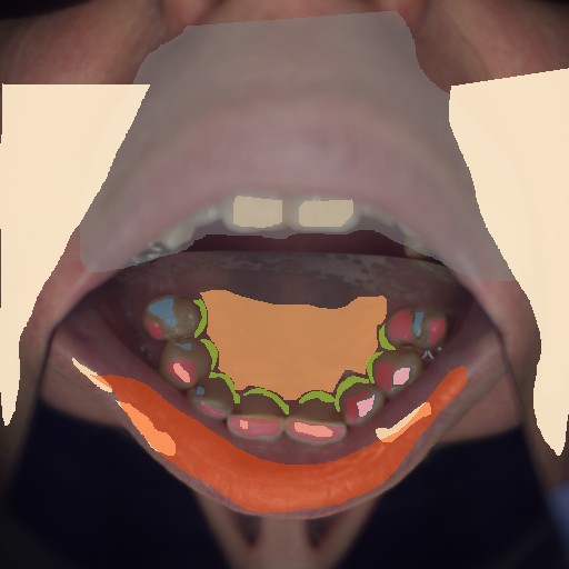 False color image render of a spectral image exhibiting attrition/erosion, enamel, hard palate, lip, marginal gingiva, out of focus area, plastic, skin and specular reflection