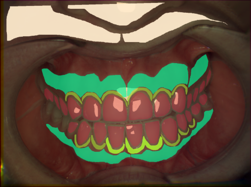 False color image render of a spectral image exhibiting attached gingiva, enamel, gingivitis, marginal gingiva, oral mucosa, skin and specular reflection
