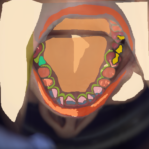 False color image render of a spectral image exhibiting attached gingiva, attrition/erosion, enamel, hard palate, lip, marginal gingiva, metal, out of focus area, plastic, prosthetics, shadow/noise, skin and specular reflection