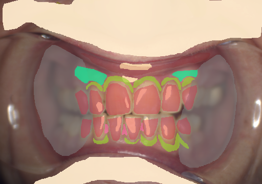 False color image render of a spectral image exhibiting attached gingiva, calculus, enamel, marginal gingiva, oral mucosa, out of focus area, shadow/noise, skin and specular reflection