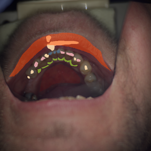 False color image render of a spectral image exhibiting attrition/erosion, lip, marginal gingiva, oral mucosa, plastic and specular reflection