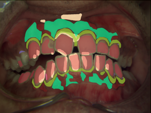 False color image render of a spectral image exhibiting attached gingiva, calculus, enamel, initial caries, marginal gingiva, oral mucosa, pigmentation, plaque, specular reflection and stain