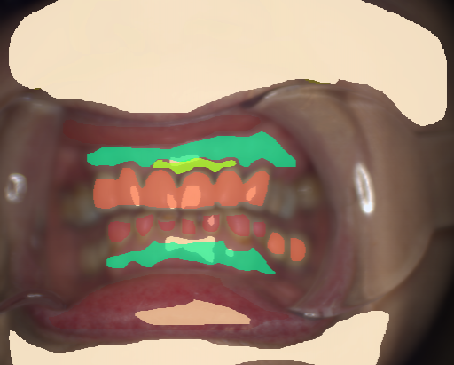 False color image render of a spectral image exhibiting attached gingiva, enamel, gingivitis, oral mucosa, prosthetics, shadow/noise, skin and specular reflection