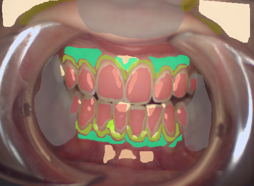 False color image render of a spectral image exhibiting attached gingiva, enamel, gingivitis, marginal gingiva, oral mucosa, out of focus area, shadow/noise, skin and specular reflection