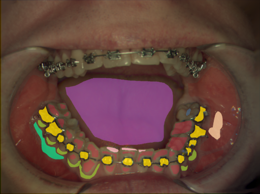 False color image render of a spectral image exhibiting attached gingiva, attrition/erosion, enamel, marginal gingiva, metal, oral mucosa, plastic, specular reflection and tongue