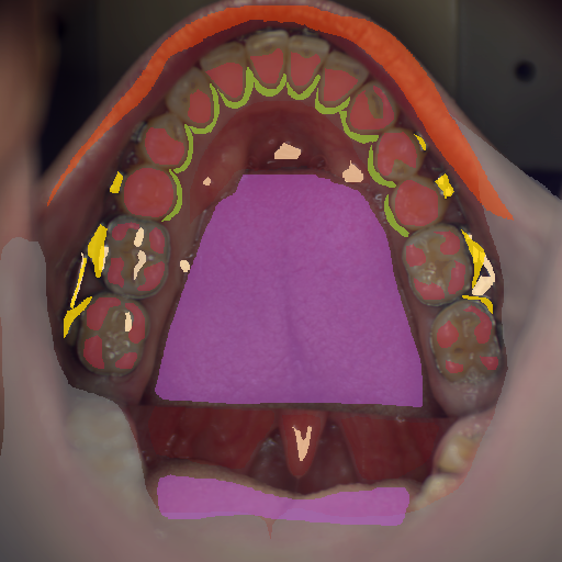 False color image render of a spectral image exhibiting enamel, lip, marginal gingiva, metal, oral mucosa, out of focus area, specular reflection, stain and tongue