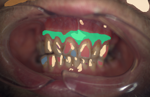 False color image render of a spectral image exhibiting attached gingiva, enamel, hair, initial caries, oral mucosa, plastic, skin, specular reflection and stain