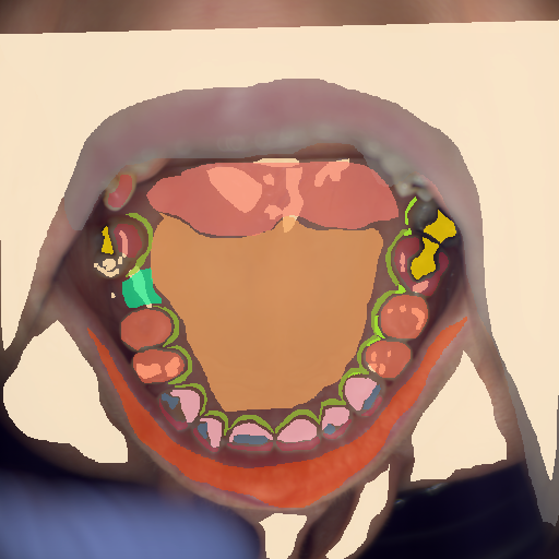 False color image render of a spectral image exhibiting attached gingiva, attrition/erosion, enamel, gingivitis, hard palate, lip, marginal gingiva, metal, out of focus area, plastic, prosthetics, skin, soft palate and specular reflection