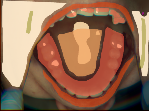 False color image render of a spectral image exhibiting hard palate, lip, mole, prosthetics, shadow/noise, skin and specular reflection