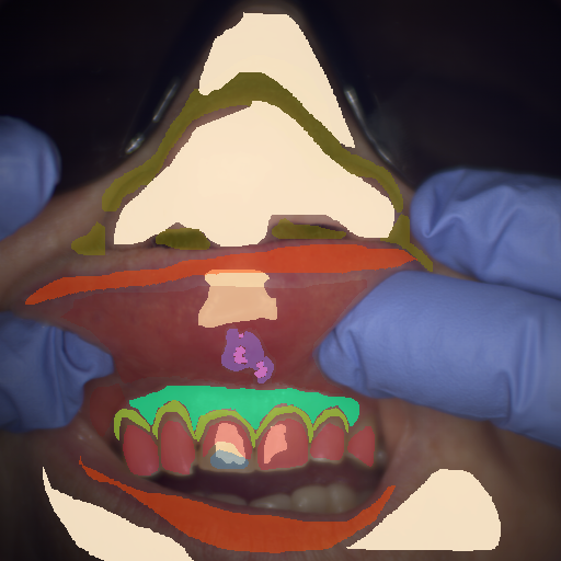 False color image render of a spectral image exhibiting attached gingiva, enamel, inflammation, lip, marginal gingiva, oral mucosa, plastic, shadow/noise, skin, specular reflection and ulcer