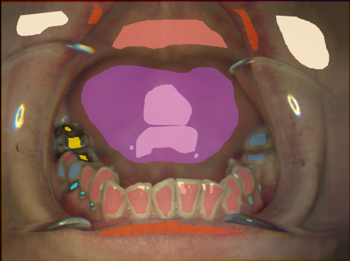 False color image render of a spectral image exhibiting dentine caries, enamel, lip, metal, plastic, root, skin, soft palate, specular reflection and tongue