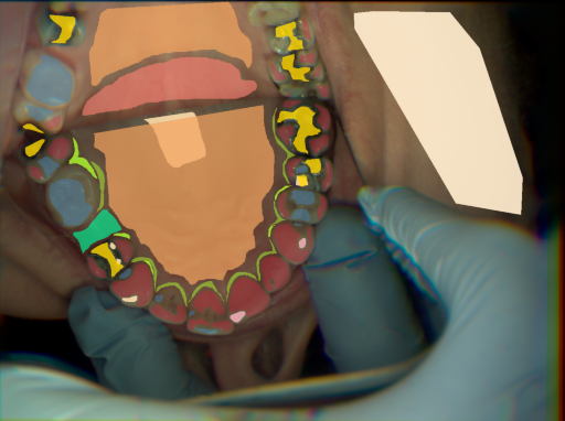False color image render of a spectral image exhibiting attached gingiva, attrition/erosion, enamel, gingivitis, hard palate, marginal gingiva, metal, plastic, skin, soft palate, specular reflection and stain