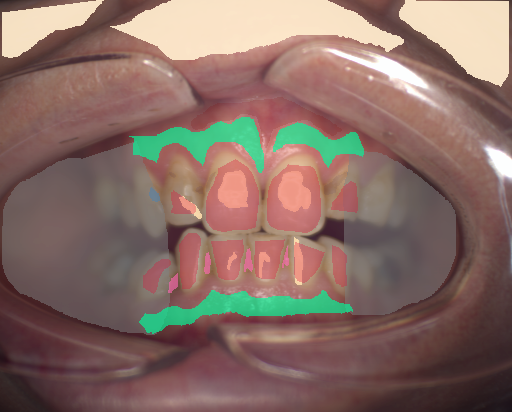 False color image render of a spectral image exhibiting attached gingiva, calculus, enamel, oral mucosa, out of focus area, plastic, shadow/noise, skin, specular reflection and stain