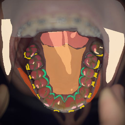 False color image render of a spectral image exhibiting attached gingiva, attrition/erosion, enamel, hard palate, lip, metal, out of focus area, skin, soft palate, specular reflection and stain