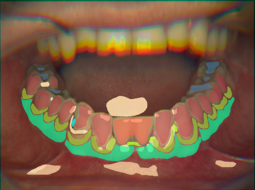 False color image render of a spectral image exhibiting attached gingiva, calculus, dentine caries, enamel, gingivitis, initial caries, marginal gingiva, oral mucosa, plastic, prosthetics and specular reflection