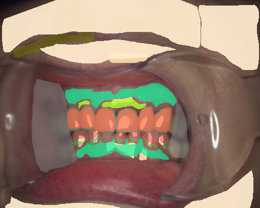 False color image render of a spectral image exhibiting attached gingiva, enamel, gingivitis, oral mucosa, out of focus area, prosthetics, root, shadow/noise, skin and specular reflection