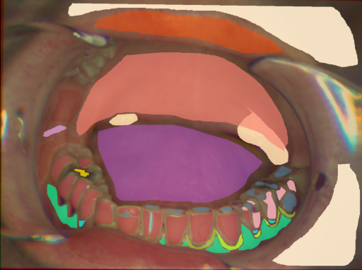 False color image render of a spectral image exhibiting attached gingiva, attrition/erosion, dentine caries, enamel, gingivitis, initial caries, leukoplakia, lip, marginal gingiva, metal, microfracture, oral mucosa, plastic, skin, soft palate, specular reflection and tongue