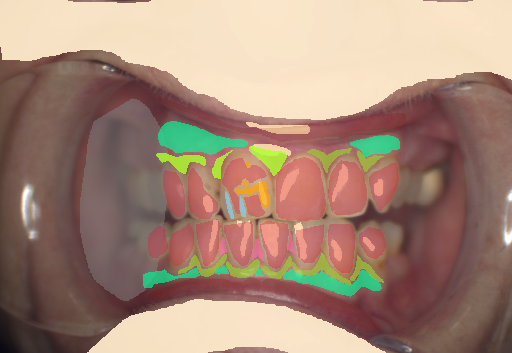 False color image render of a spectral image exhibiting attached gingiva, calculus, enamel, gingivitis, makeup, marginal gingiva, microfracture, oral mucosa, out of focus area, shadow/noise, skin, specular reflection and stain