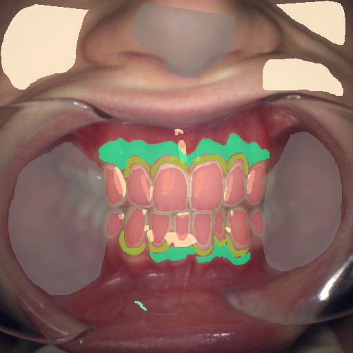 False color image render of a spectral image exhibiting attached gingiva, blood vessel, enamel, marginal gingiva, oral mucosa, out of focus area, skin and specular reflection