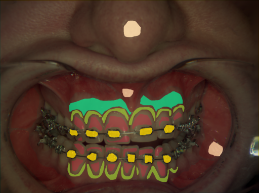 False color image render of a spectral image exhibiting attached gingiva, enamel, marginal gingiva, metal, oral mucosa and specular reflection