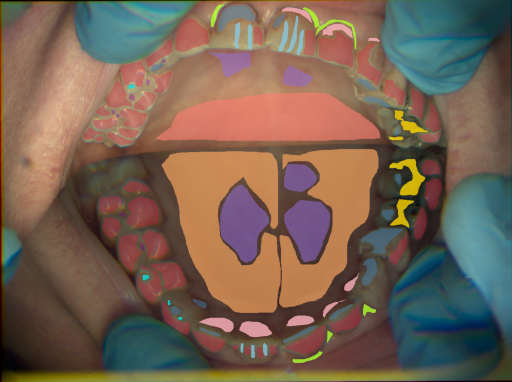 False color image render of a spectral image exhibiting attrition/erosion, dentine caries, enamel, gingivitis, hard palate, inflammation, initial caries, metal, microfracture, plastic and soft palate