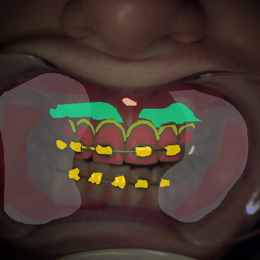 False color image render of a spectral image exhibiting attached gingiva, enamel, marginal gingiva, metal, oral mucosa, out of focus area and specular reflection