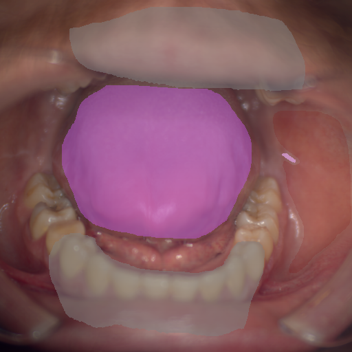 False color image render of a spectral image exhibiting leukoplakia, oral mucosa, out of focus area and tongue