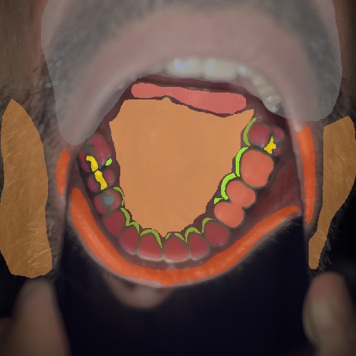 False color image render of a spectral image exhibiting enamel, gingivitis, hair, hard palate, lip, marginal gingiva, metal, oral mucosa, out of focus area, plastic, prosthetics, soft palate and stain