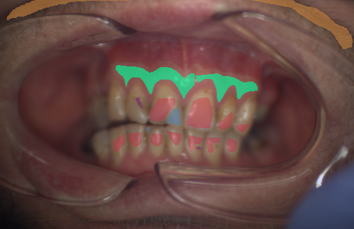 False color image render of a spectral image exhibiting attached gingiva, enamel, hair, initial caries, oral mucosa and plastic