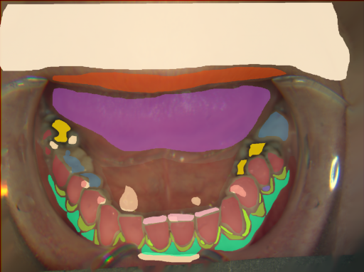 False color image render of a spectral image exhibiting attached gingiva, attrition/erosion, enamel, gingivitis, lip, marginal gingiva, metal, oral mucosa, plaque, plastic, skin, specular reflection and tongue