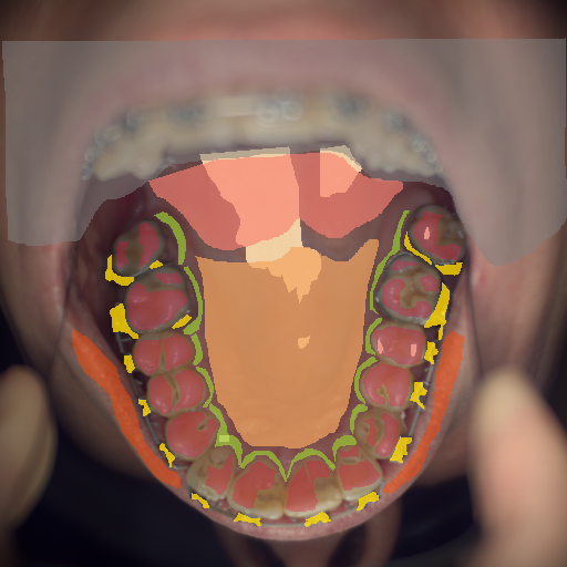 False color image render of a spectral image exhibiting enamel, hard palate, lip, marginal gingiva, metal, out of focus area, soft palate, specular reflection and stain