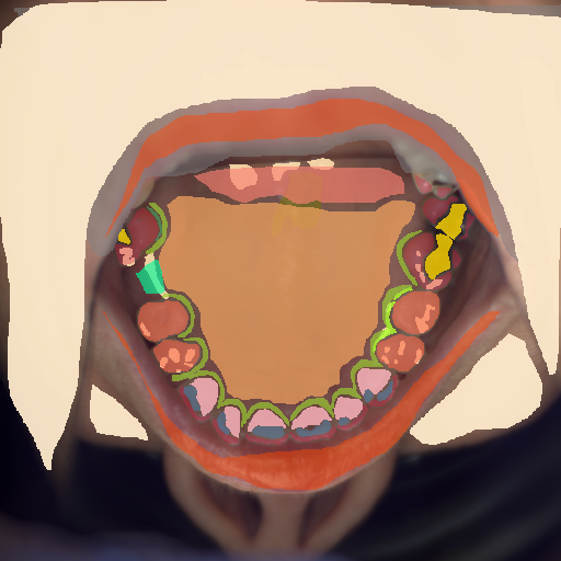 False color image render of a spectral image exhibiting attached gingiva, attrition/erosion, enamel, gingivitis, hard palate, lip, marginal gingiva, metal, out of focus area, plastic, prosthetics, root, shadow/noise, skin, soft palate, specular reflection and stain