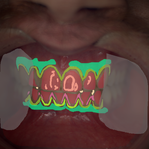 False color image render of a spectral image exhibiting attached gingiva, calculus, enamel, gingivitis, marginal gingiva, oral mucosa, out of focus area and specular reflection