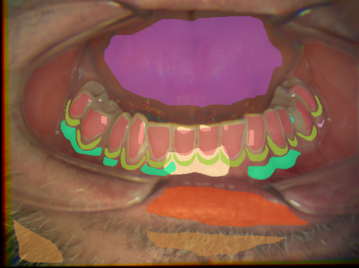False color image render of a spectral image exhibiting attached gingiva, dentine caries, enamel, hair, initial caries, leukoplakia, lip, marginal gingiva, oral mucosa, specular reflection and tongue