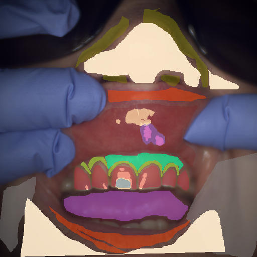 False color image render of a spectral image exhibiting attached gingiva, enamel, inflammation, lip, marginal gingiva, oral mucosa, out of focus area, plastic, shadow/noise, skin, specular reflection, tongue and ulcer