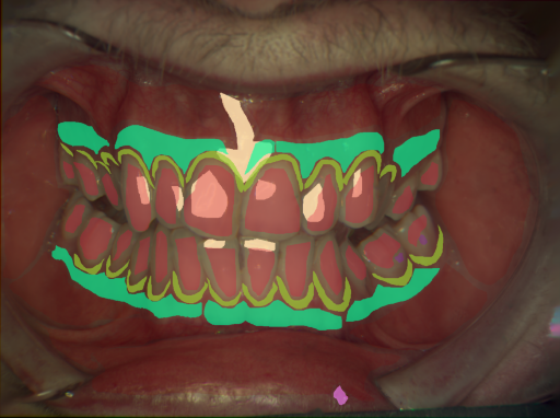 False color image render of a spectral image exhibiting attached gingiva, enamel, initial caries, marginal gingiva, oral mucosa, specular reflection, stain and ulcer