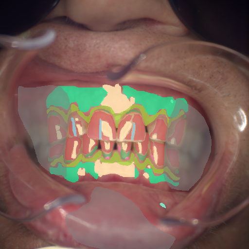 False color image render of a spectral image exhibiting attached gingiva, blood vessel, calculus, enamel, marginal gingiva, microfracture, out of focus area, root, specular reflection and stain