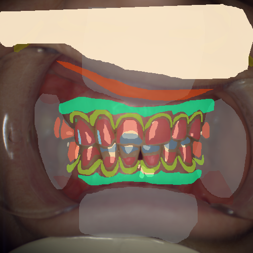 False color image render of a spectral image exhibiting attached gingiva, enamel, lip, marginal gingiva, microfracture, oral mucosa, out of focus area, plastic, prosthetics, root, shadow/noise, skin and specular reflection