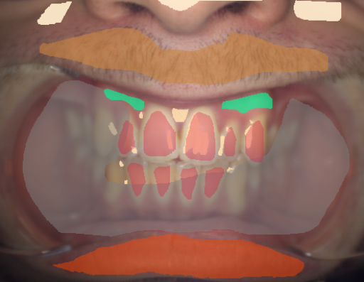 False color image render of a spectral image exhibiting attached gingiva, enamel, hair, lip, out of focus area, skin and specular reflection