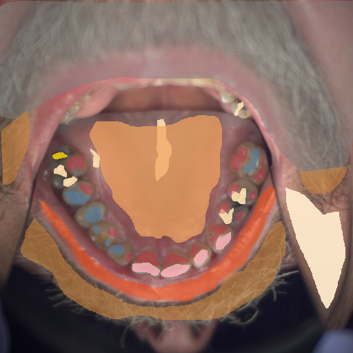 False color image render of a spectral image exhibiting attrition/erosion, enamel, hair, hard palate, lip, metal, out of focus area, plastic, skin, specular reflection and stain