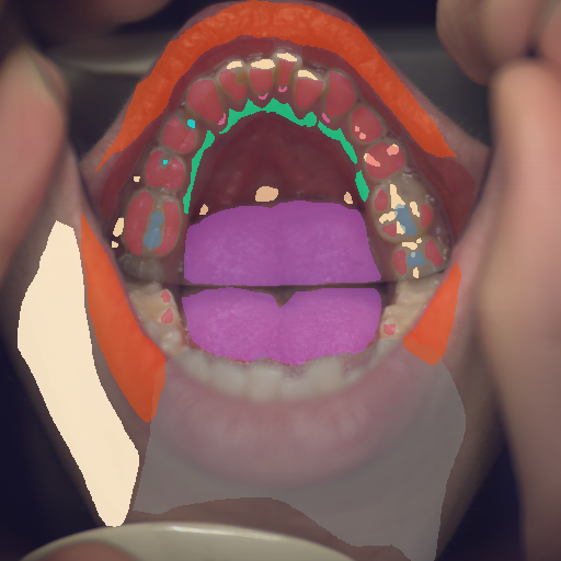 False color image render of a spectral image exhibiting attached gingiva, calculus, dentine caries, enamel, lip, oral mucosa, out of focus area, plastic, skin, specular reflection and tongue