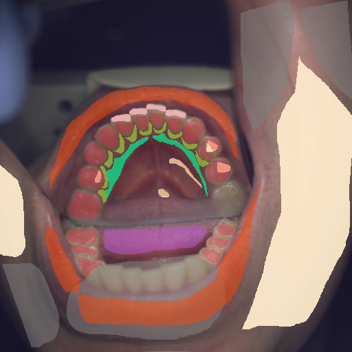 False color image render of a spectral image exhibiting attached gingiva, attrition/erosion, enamel, lip, marginal gingiva, oral mucosa, out of focus area, skin, specular reflection and tongue