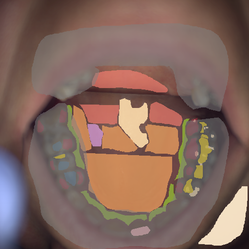 False color image render of a spectral image exhibiting attrition/erosion, enamel, hard palate, leukoplakia, marginal gingiva, metal, out of focus area, plastic, skin, soft palate and specular reflection