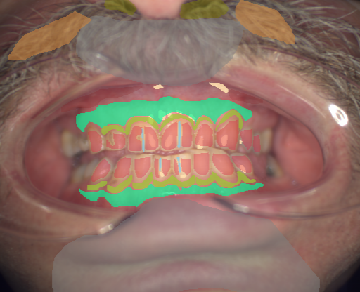 False color image render of a spectral image exhibiting attached gingiva, enamel, hair, marginal gingiva, microfracture, oral mucosa, out of focus area, shadow/noise, specular reflection and stain