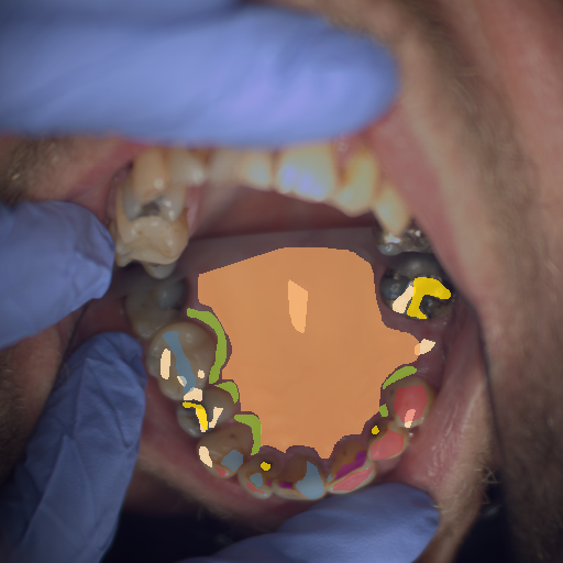 False color image render of a spectral image exhibiting enamel, hard palate, initial caries, marginal gingiva, metal, plastic and specular reflection